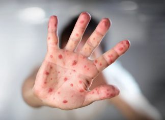 ¿Qué dijo el Minsal ante la nueva alerta de la OMS por viruela del mono?