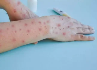 Colmed advierte que grupos de riesgo para vacunación por viruela del mono podrían cambiar ante nueva cepa